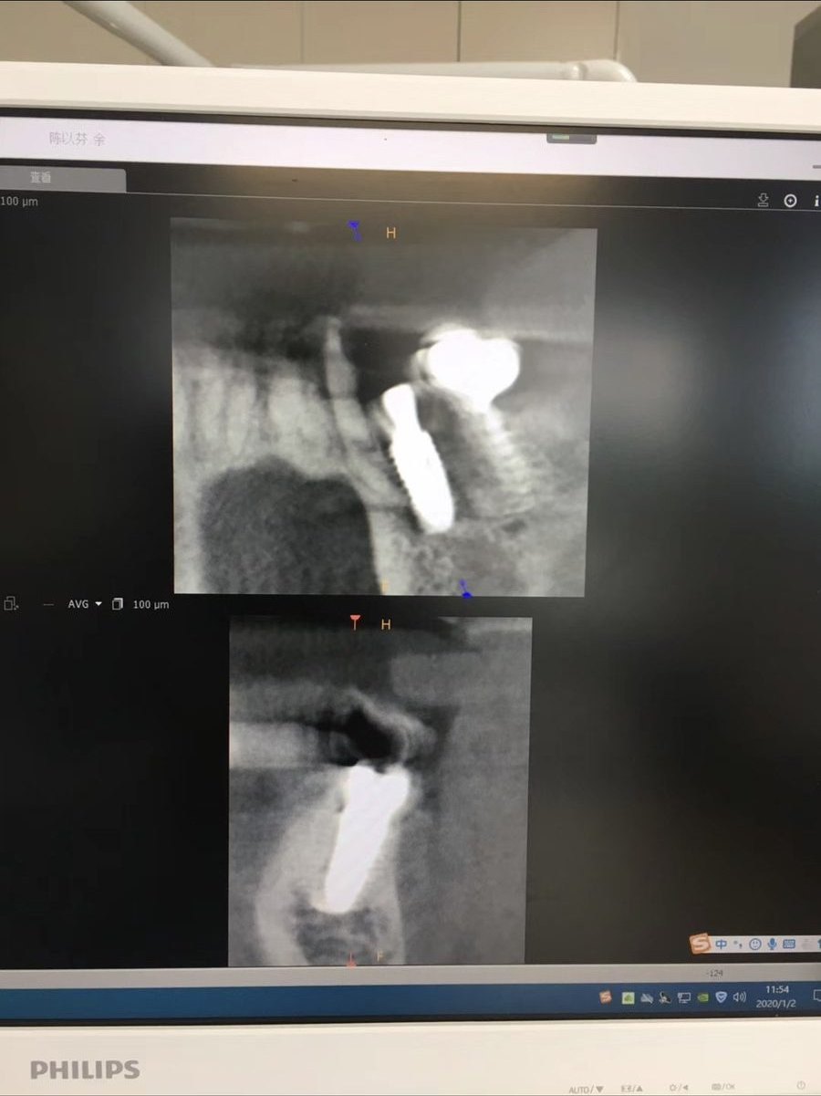 诊疗影像记录 · 根尖片